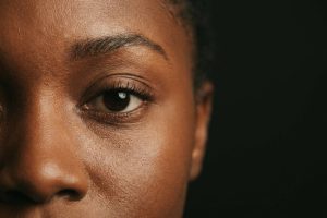 Sample photo for Eyelid cyst removal (model image)