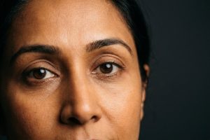 Sample photo for Eyelid retraction surgery (model image)