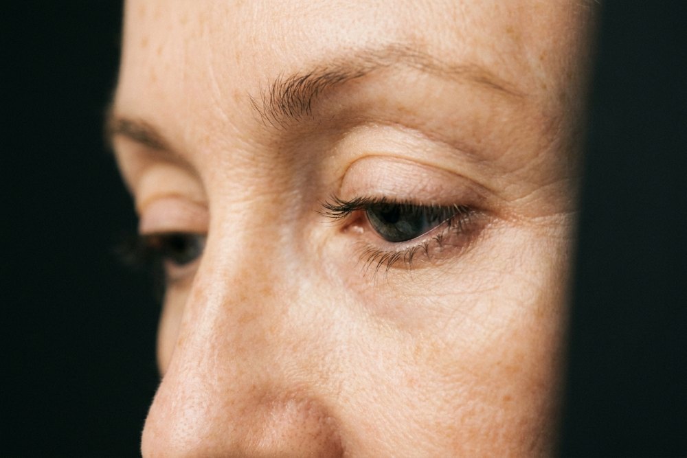 Sample photo for Ingrowing eyelashes (model image)