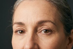 Sample photo for Upper eyelid surgery (model image)