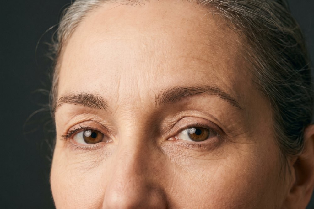 Sample photo for Upper eyelid surgery (model image)